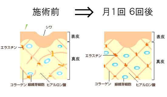 フォトフェイシャルでシワ改善