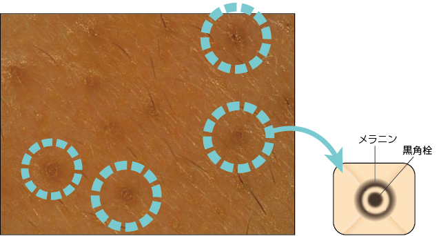 毛穴の黒ずみ